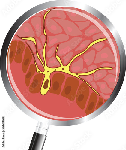 The site of the human skin under a magnifying glass. Albinism. Vector illustration.