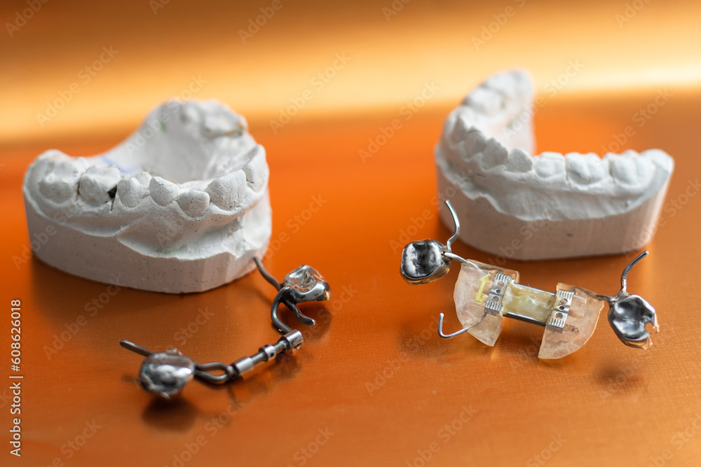 Dental models top view. Jaw models with different problems. Treatment