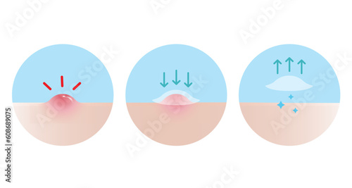 How to use acne pimple patch for inflammatory acne vector icon set illustration on white background. Step of use, direction for use acne patch absorbing papule on skin face. Skin care concept. photo