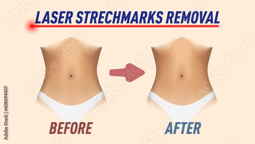 Laser Strechmarks Removal Ad. Before And After