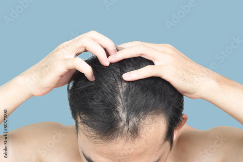 Closeup Young man serious hair loss problem with blue backgroun for health care medical and shampoo product concept, selective focus