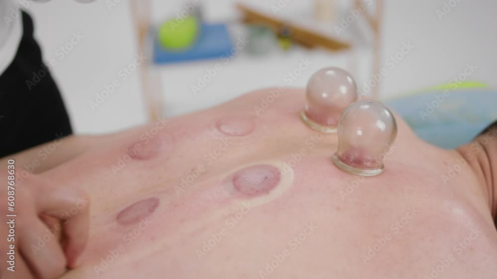 Closeup to the camera the therapist take of the vacuum cups from back of his client after he end to massage his back at spa salon or medical clinic Closeup to the camera the therapist take of the vacuum cups from back of his client after he end to massage his back at spa salon or medical clinic