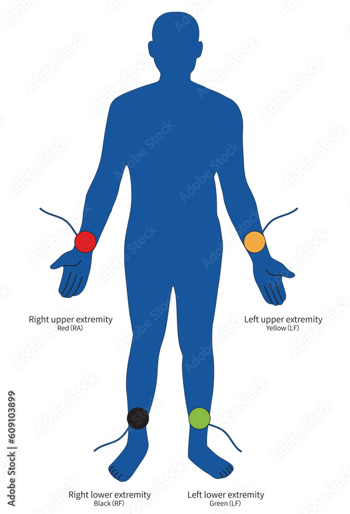 Standard bipolar limb leads constitute leads I, II and III of the ECG