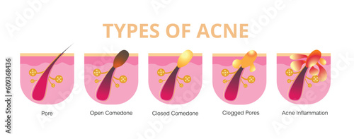 Acne, stages of development,healthy skin,vector design