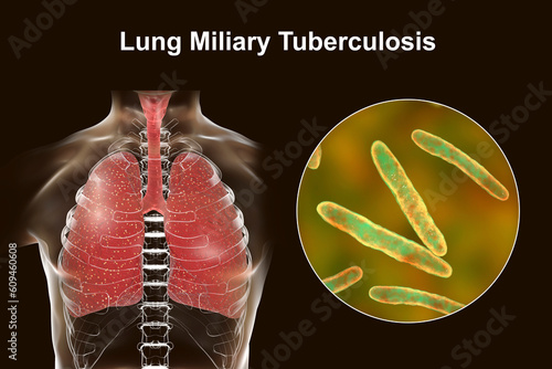 A detailed 3D illustration showcasing human lungs affected by miliary tuberculosis, with a close-up view of the Mycobacterium tuberculosis bacteria photo