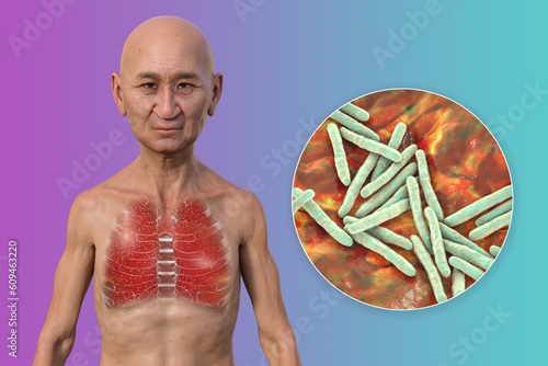 A 3D illustration of a man with transparent skin, showcasing the lungs affected by miliary tuberculosis and close-up view of Mycobacterium tuberculosis bacteria photo