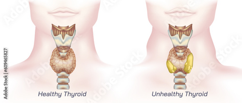 hypothyroidism vs hyperthyroidism. healthy and unhealthy thyroid test. Thyroid tumour and inflammation treatment. Parathyroid glands. neck pain and sore. Throat cancer and esophagus. Goitre problem. 