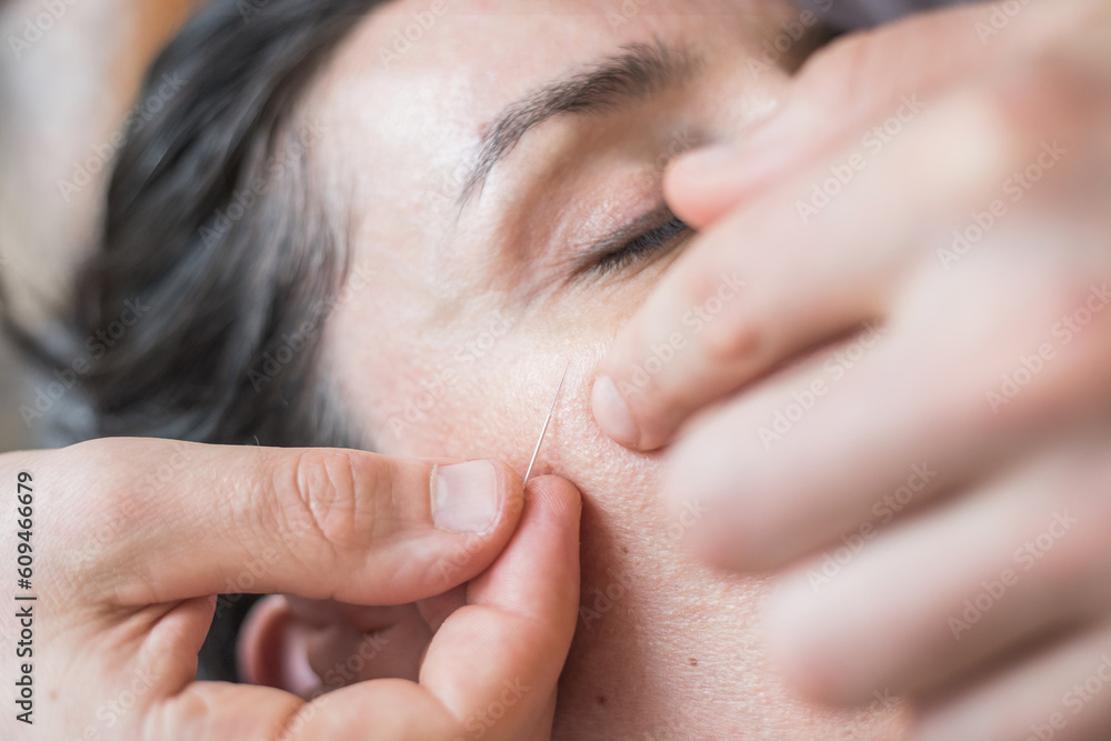 Young Caucasian woman having acupuncture sessions on her face as a beauty, anti-aging treatment. Concept of controlled aging and beauty and body care. Close-up view of the procedure. Selective focus Young Caucasian woman having acupuncture sessions on her face as a beauty, anti-aging treatment. Concept of controlled aging and beauty and body care. Close-up view of the procedure. Selective focus