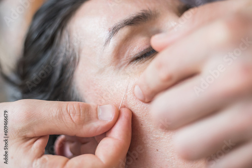 Young Caucasian woman having acupuncture sessions on her face as a beauty, anti-aging treatment. Concept of controlled aging and beauty and body care. Close-up view of the procedure. Selective focus