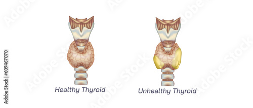 hypothyroidism vs hyperthyroidism. healthy and unhealthy thyroid test. Thyroid tumour and inflammation treatment. Parathyroid glands. neck pain and sore. Throat cancer and esophagus. Goitre problem. 