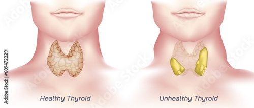hypothyroidism vs hyperthyroidism. healthy and unhealthy thyroid test. Thyroid tumour and inflammation treatment. Parathyroid glands. neck pain and sore. Throat cancer and esophagus. Goitre problem. 