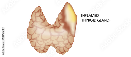 hypothyroidism vs hyperthyroidism. healthy and unhealthy thyroid test. Thyroid tumour and inflammation treatment. Parathyroid glands. neck pain and sore. Throat cancer and esophagus. Goitre problem. 
