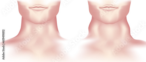 hypothyroidism vs hyperthyroidism. healthy and unhealthy thyroid test. Thyroid tumour and inflammation treatment. Parathyroid glands. neck pain and sore. Throat cancer and esophagus. Goitre problem. 