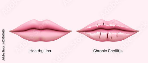 Chronic angular cheilitis problem. Dry chapped lips vector illustration. symptoms of Ripped lips skin. Disease of the mouth. sore lips, skin flakes. Vector illustration. lips ulcer and cancer symptoms