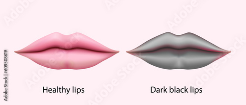 Chronic angular cheilitis problem. Dry chapped lips vector illustration. symptoms of Ripped lips skin. Disease of the mouth. sore lips, skin flakes. Vector illustration. lips ulcer and cancer symptoms
