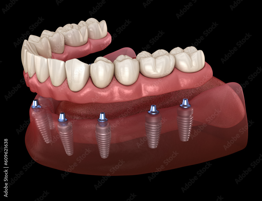 Mandibular prosthesis with gum All on 6 system supported by implants. Medically accurate 3D illustration of human teeth and dentures concept Mandibular prosthesis with gum All on 6 system supported by implants. Medically accurate 3D illustration of human teeth and dentures concept