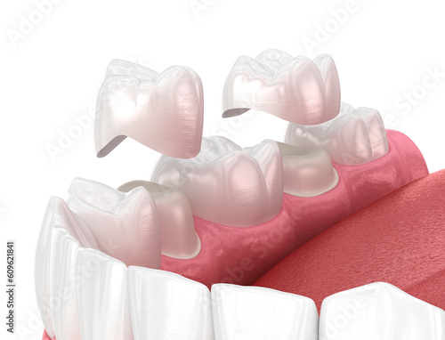 Fototapeta Naklejka Na Ścianę i Meble -  Porcelain crowns placement over premolar and molar teeth. . Medically accurate 3D illustration