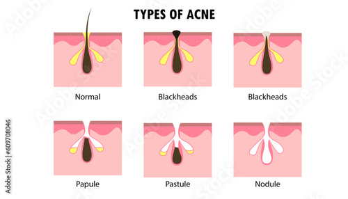 Diagram of the Types of acnes on the skin