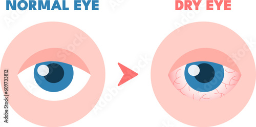 Dry eyes. Healthy unhealthy red eye, driing astonished redness irritated surface eyeball, conjunctivitis glaucoma disease or lens allergies photo