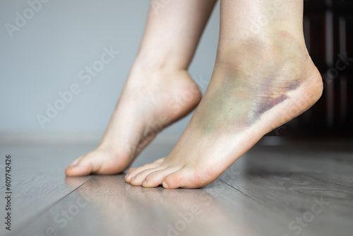 Leg with hematoma. Foot with hematoma. Ankle with bruise. Twisted ankle. Bruise injury on woman foot. Ankle injury with dislocation and sprains. © JuliaWoźniak