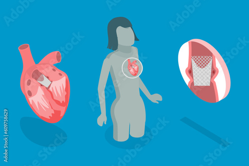 3D Isometric Flat Vector Conceptual Illustration of Transcutaneous Aortic Valve Replacement - TAVR, Minimally Invasive Surgery