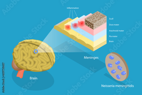 3D Isometric Flat Vector Conceptual Illustration of Meningitis, Human Brain and Meningococcal Bacteria photo