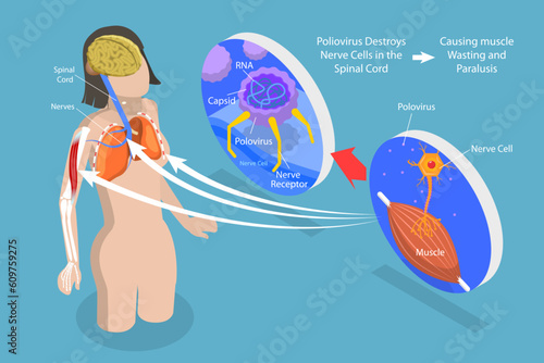 3D Isometric Flat Vector Conceptual Illustration of Poliomyelitis, Labeled Medical Virus Infection Symptoms Explanation scheme photo