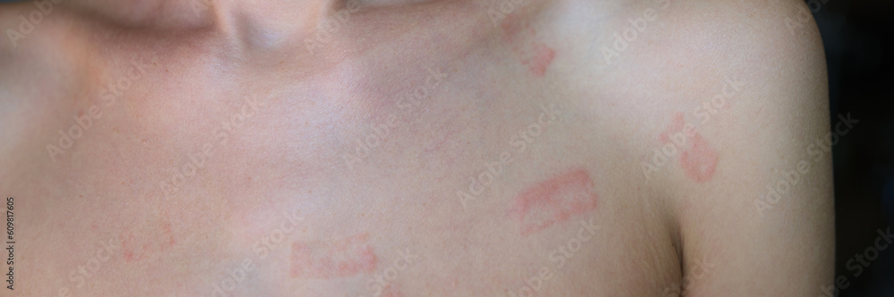 Fototapeta premium Red allergic spots rash on female body. Erythema causes symptoms of the disease