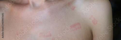 Red allergic spots rash on female body. Erythema causes symptoms of the disease
