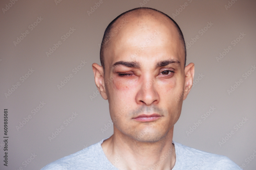 Obraz premium Caucasian man has angioedema around the eyes caused by allergic reaction to agents such as insect bites, foods, or medications. Swollen face.