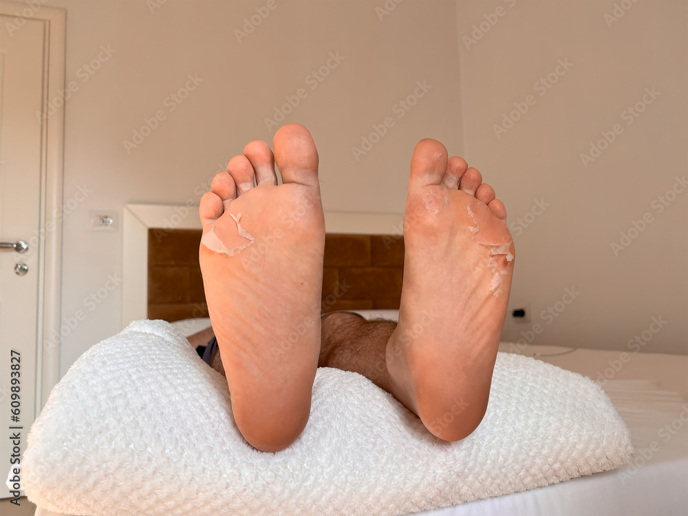 sweaty feet skin peeling. close up of peeling and cracked foot
