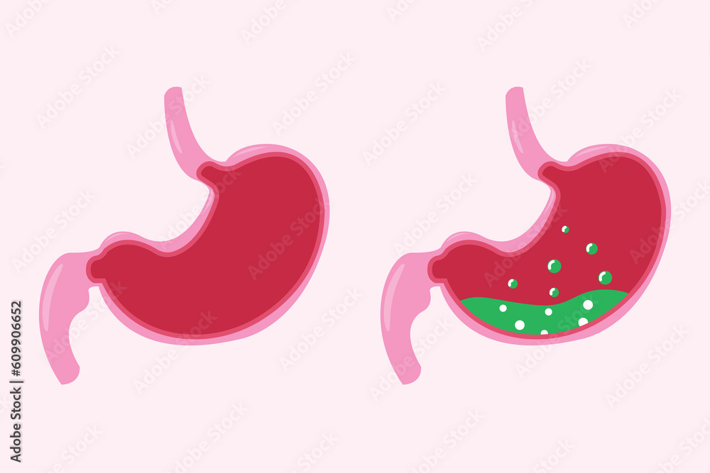 Stomach icon set, cartoon vector illustration. cross section of normal and abnormal stomach Stomach icon set, cartoon vector illustration. cross section of normal and abnormal stomach