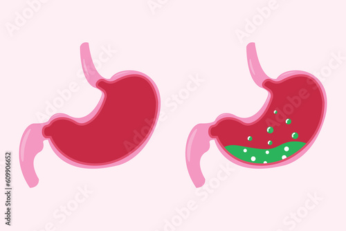 Stomach icon set, cartoon vector illustration. cross section of normal and abnormal stomach
