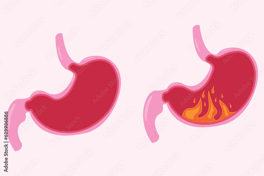 Stomach icon set, cartoon vector illustration. cross section of normal and abnormal stomach. health and unhealth stomach. eps 10 Stomach icon set, cartoon vector illustration. cross section of normal and abnormal stomach. health and unhealth stomach. eps 10