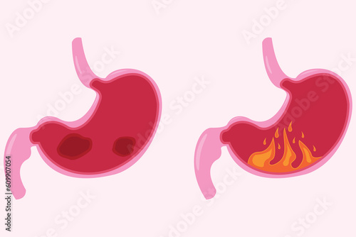 Stomach icon set, cartoon vector illustration. cross section of normal and abnormal stomach