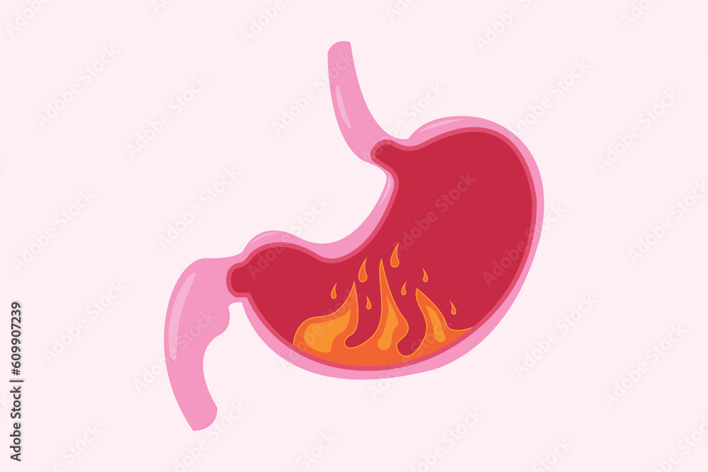 Illustration from acid reflux or heartburn, Cartoon vector, Concept with internal health. fire in stomach. eps 10 Illustration from acid reflux or heartburn, Cartoon vector, Concept with internal health. fire in stomach. eps 10