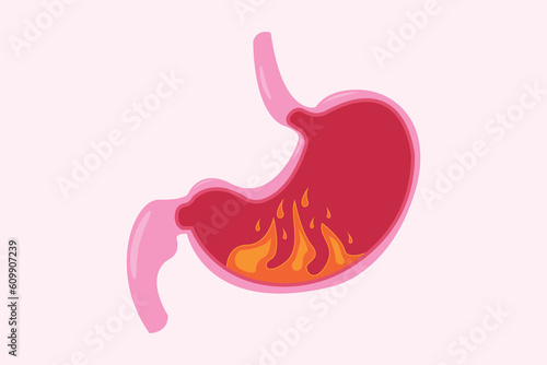 Illustration from acid reflux or heartburn, Cartoon vector, Concept with internal health. fire in stomach. eps 10