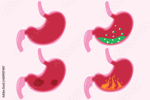 Stomach icon set, cartoon vector illustration. cross section of normal and abnormal stomach	