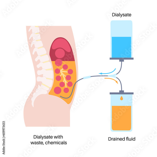 Peritoneal dialysis concept