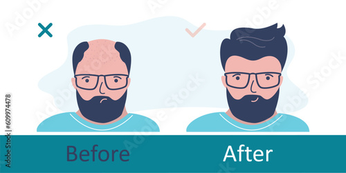 Bald man before and after hair transplantation. Unhappy person with hair loss problem, alopecia, front view. Hair transplant surgery. Healthy hair. Head baldness problem solving surgery.