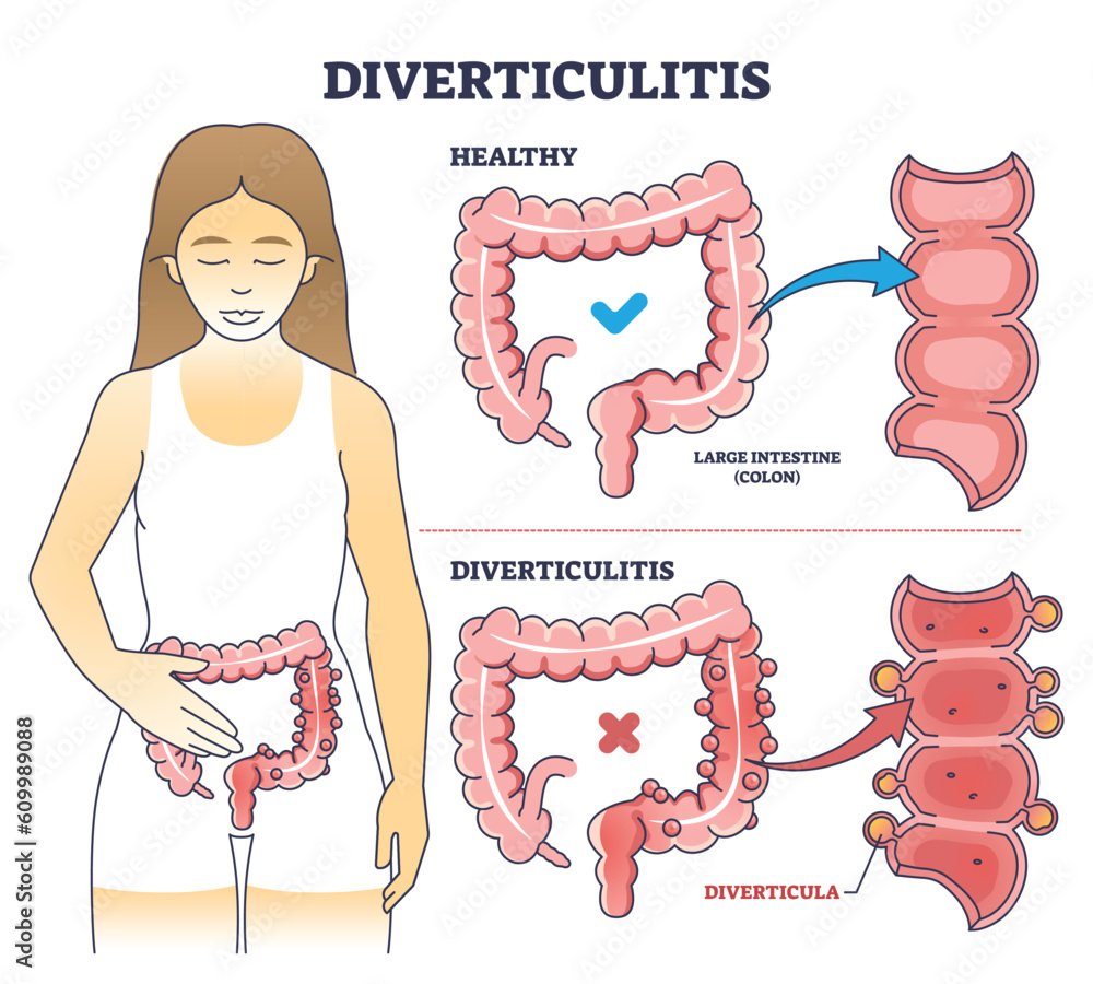 Diverticulitis Anatomical Vector Illustration Diagram vrogue.co