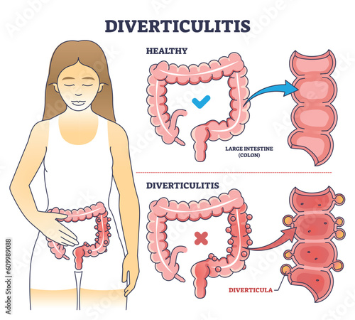 Diverticulitis as digestive conditions for large intestine outline diagram. Labeled educational scheme with colon problem vector illustration. Anatomical explanation for digestive system inflammation photo