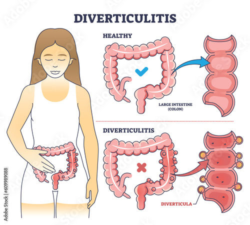 Diverticulitis as digestive conditions for large intestine outline diagram. Labeled educational scheme with colon problem vector illustration. Anatomical explanation for digestive system inflammation