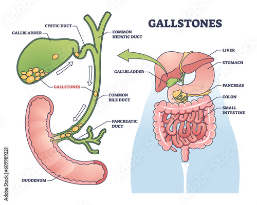 Gallstones as stones of cholesterol in gallbladder outline diagram. Labeled educational scheme with bile ducts blockage and painful problem vector illustration. Anatomical and medical explanation.