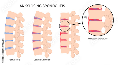 fused spine disk of kyphosis lordosis or scoliosis kyphoscoliosis disease in axial ankylosing spondylitis osteoporosis the skeletal pelvis stiffness with chronic knee ankle spondylolysis