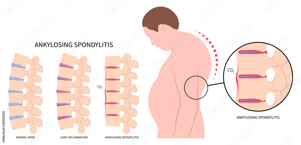 spondylolysis fused spine disk of kyphosis lordosis or scoliosis kyphoscoliosis disease in axial ankylosing spondylitis osteoporosis the skeletal pelvis stiffness with chronic knee ankle spondylolysis fused spine disk of kyphosis lordosis or scoliosis kyphoscoliosis disease in axial ankylosing spondylitis osteoporosis the skeletal pelvis stiffness with chronic knee ankle