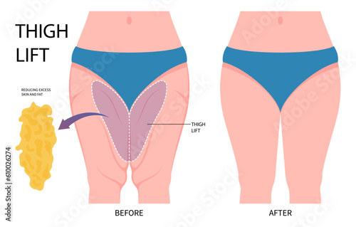 cosmetic weight loss Thigh lift or Thighplasty leg bariatric surgery with body hip Liposuction cellulite reducing contour of mass Index and BMI removal