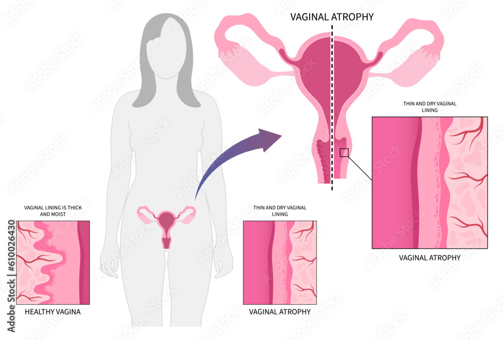 postmenopausal Vaginal atrophy level cervix drying pain tract or UTI canal cycle stop screen exam of Pap smear test cancer pelvic with birth control pills postmenopausal Vaginal atrophy level cervix drying pain tract or UTI canal cycle stop screen exam of Pap smear test cancer pelvic with birth control pills