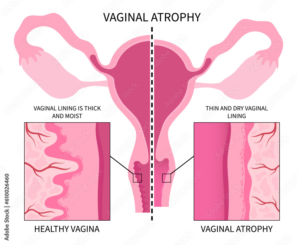 Vaginal atrophy level cervix drying pain tract or UTI canal cycle stop