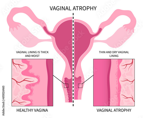 Vaginal atrophy level cervix drying pain tract or UTI canal cycle stop postmenopausal screen exam of Pap smear test cancer pelvic with birth control pills